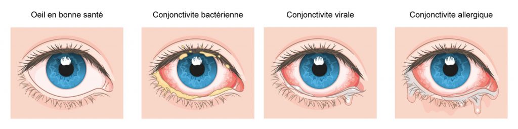 Schéma des trois types de conjonctivites possibles